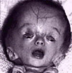 Caso patológico: hidrocefalia