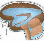 Esquema de hidrocefalia